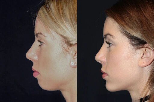Chin Fillers Treatment in Dubai: Natural Results Guaranteed