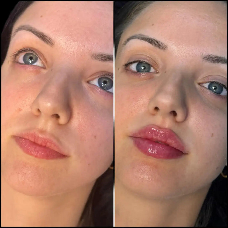 Best Plastic Surgeons in dubai for Achieving Natural Facial Contouring with Fillers