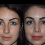 Rhinoplasty in Dubai
