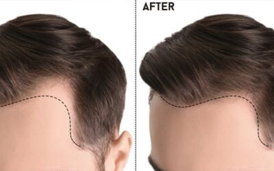 Best Hair Transplant in Pakistan