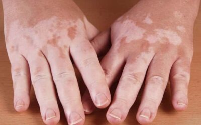 Vitiligo Treatment