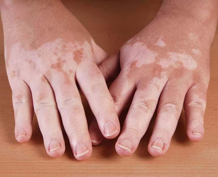 Vitiligo Treatment