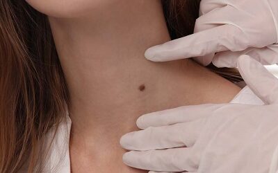 Achieving Skin Perfection: The Art of Skin Tag Removal