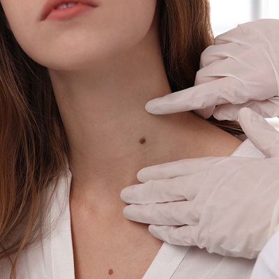 Achieving Skin Perfection: The Art of Skin Tag Removal