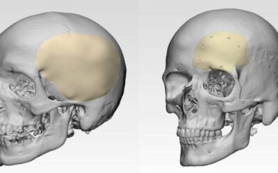 Cranial Implants Market