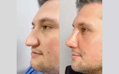 male rhinoplasty