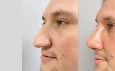 male rhinoplasty