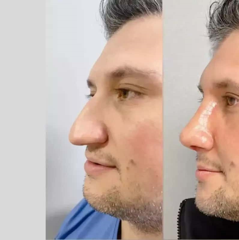 male rhinoplasty