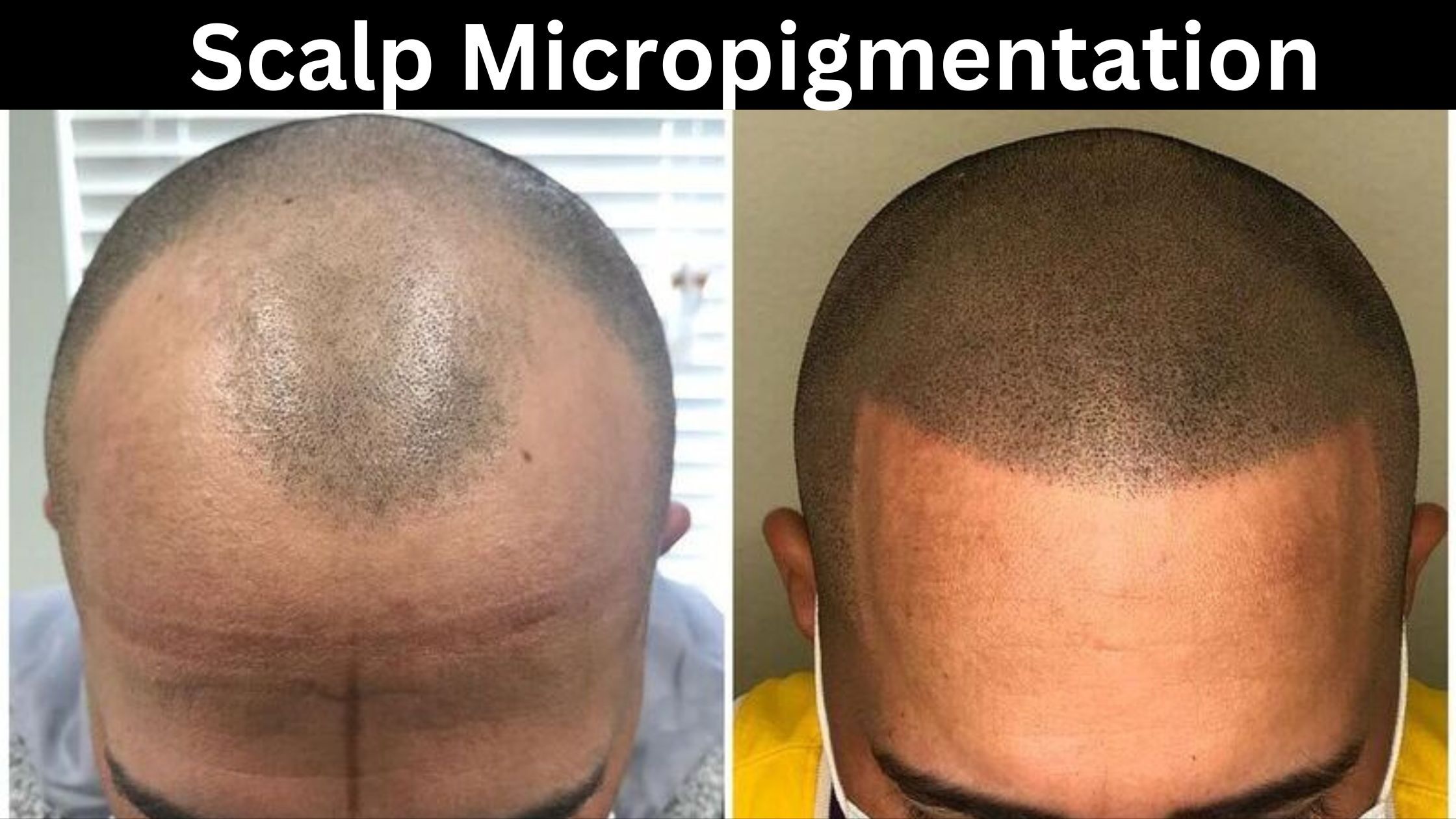 scalp micropigmentation