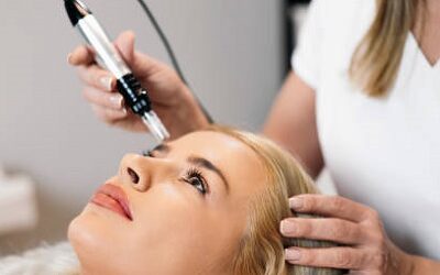 microneedling