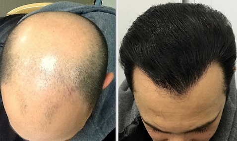 Best Hair Transplant