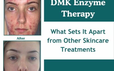 DMK-Enzyme-Therapy-What-Sets-It-Apart-from-Other-Skincare-Treatments