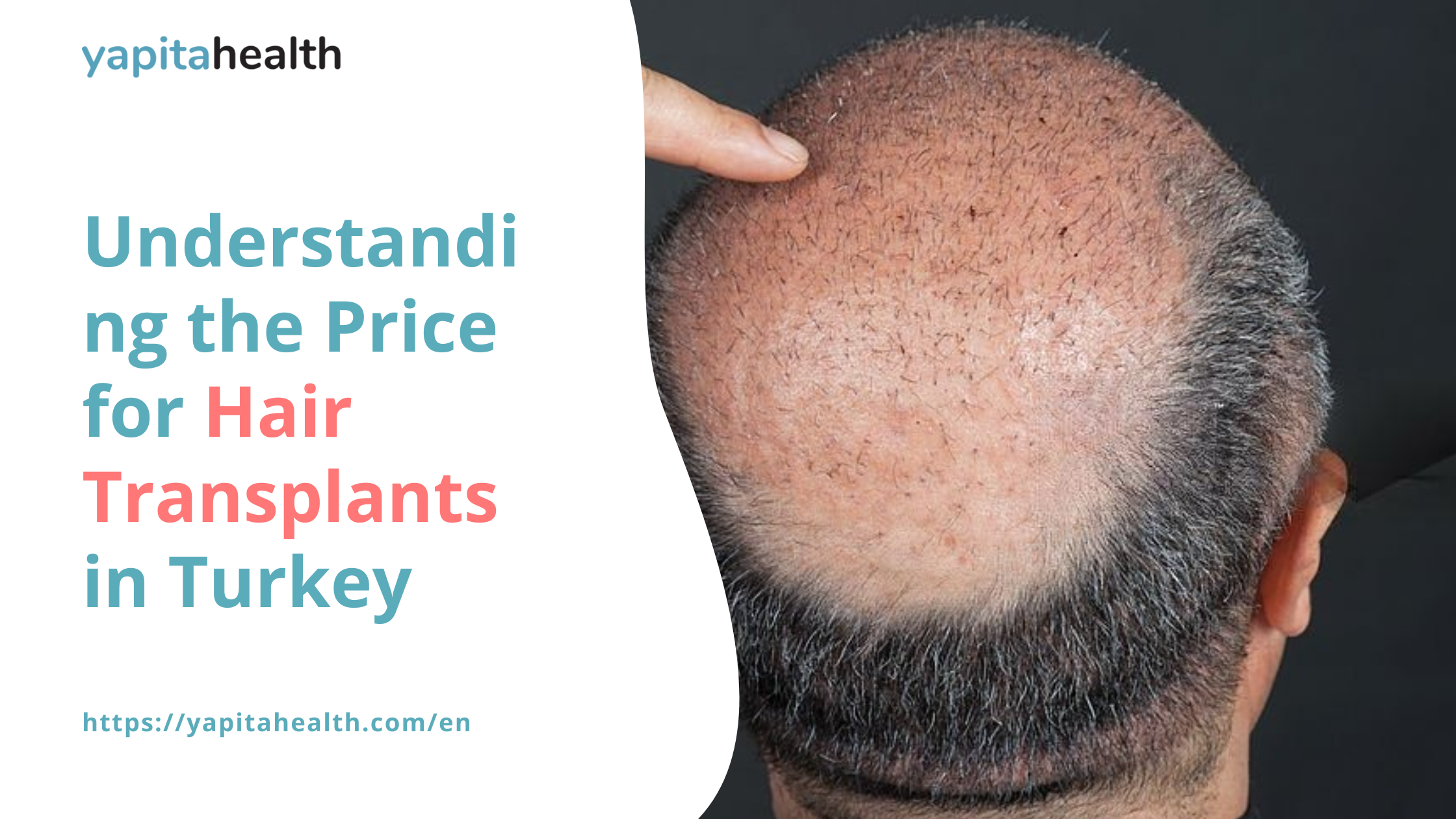 Hair Transplant in Turkey