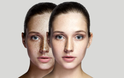 Under Standing Pigmentation and Its types and causes