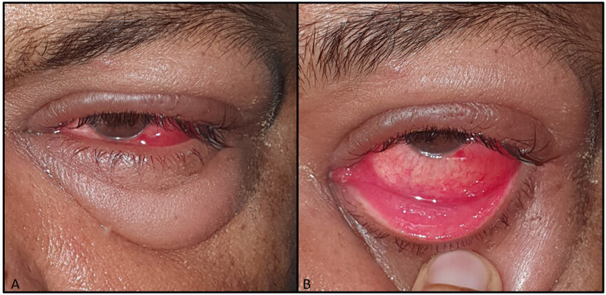 conjunctivitis treatment