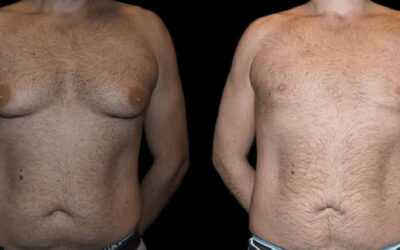 male breast reduction with before and after photo