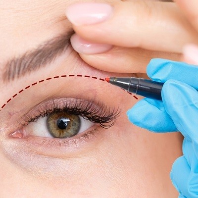 Eyelid Surgery in Islamabad