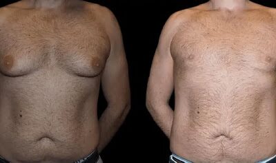 Before and after male breast reduction results