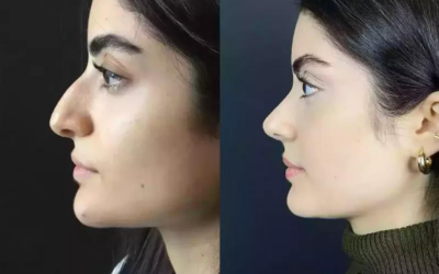 How to Prepare for Rhinoplasty Surgery in Dubai