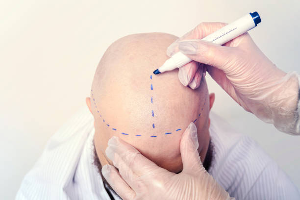 Hair Transplant Cost in Abu Dhabi