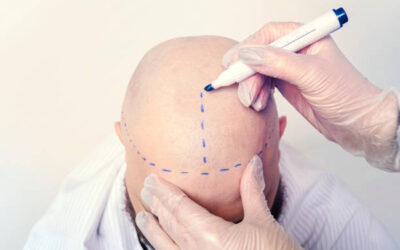 Hair Transplant Cost in Abu Dhabi