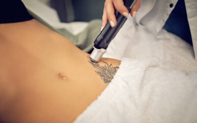 laser tattoo removal in Abu Dhabi