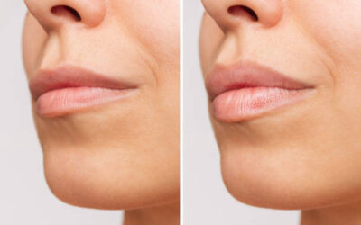 Lip Fillers injection in Abu Dhabi