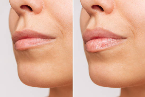 Lip Fillers injection in Abu Dhabi