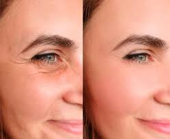 How Much Does Botox Cost in Dubai? Pricing, Clinics & What to Expect