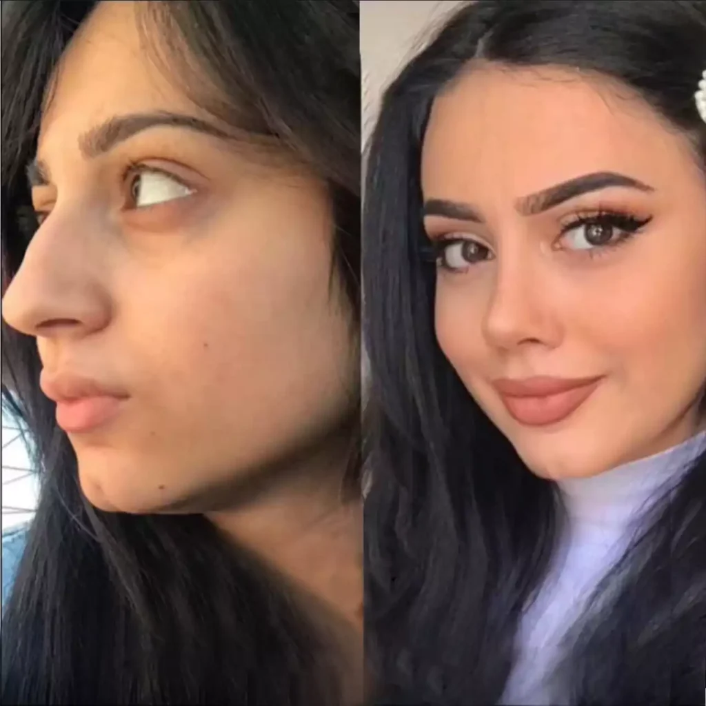 septoplasty in dubai
