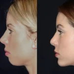 Safe and Effective Chin Fillers with the Best Plastic Surgeons in dubai