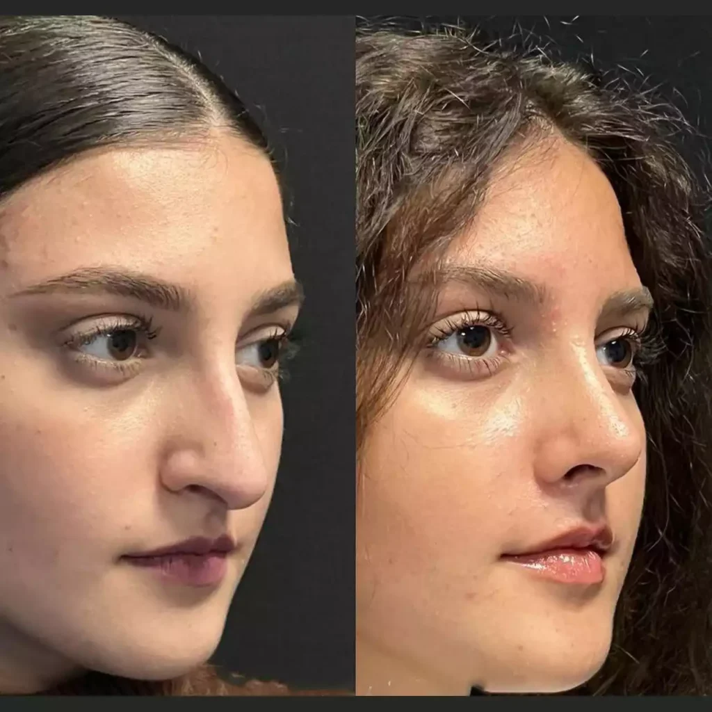rhinoplasty in dubai