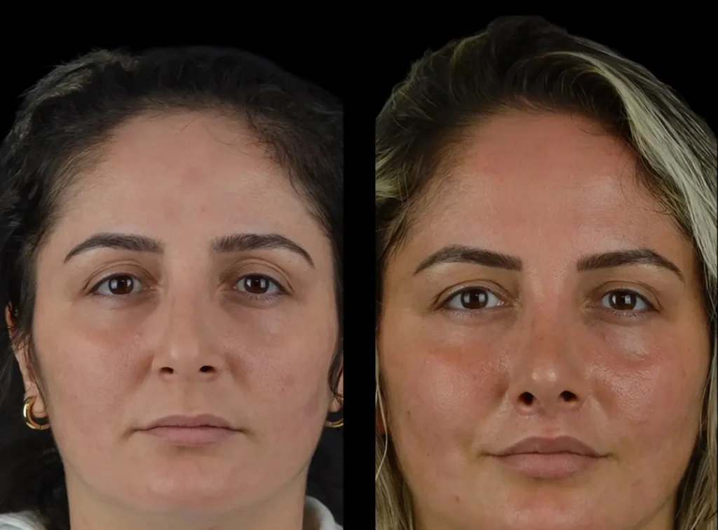 How the Best Aesthetic Clinic in Dubai Uses Cheek Fillers for Beautiful Results