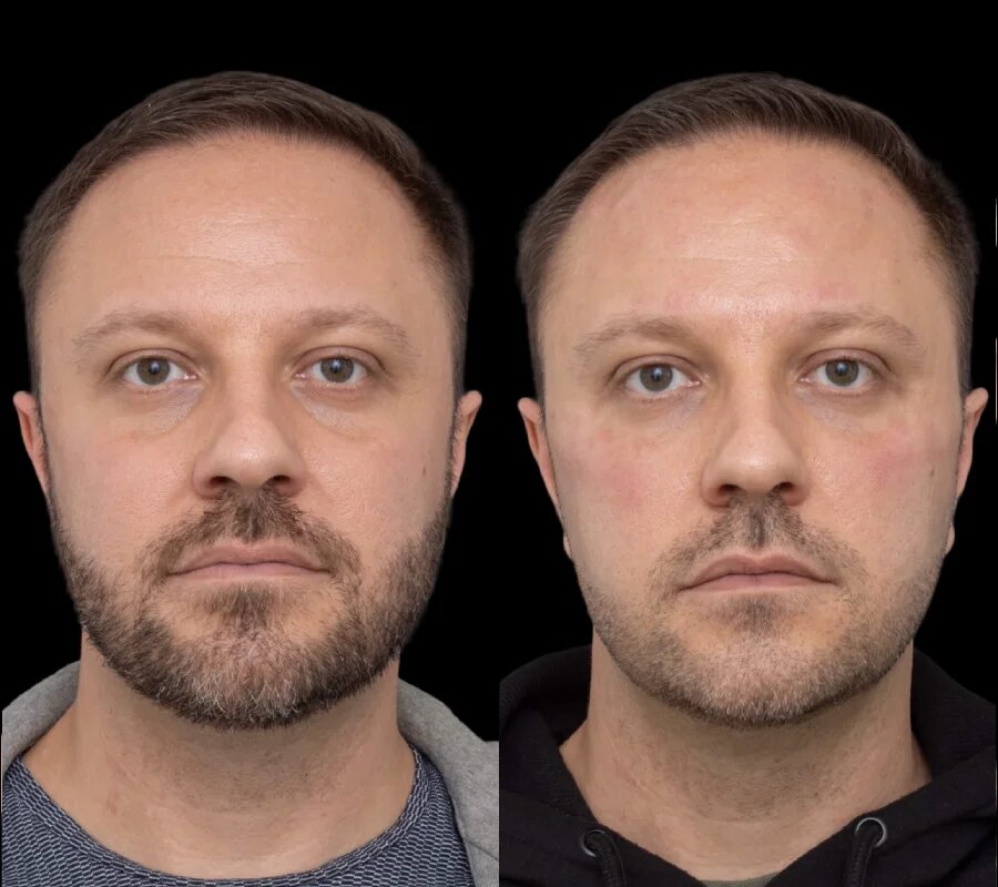 The Role of Follow-Up Care at the Best Aesthetic Clinic in Dubai After Under Eye Fillers
