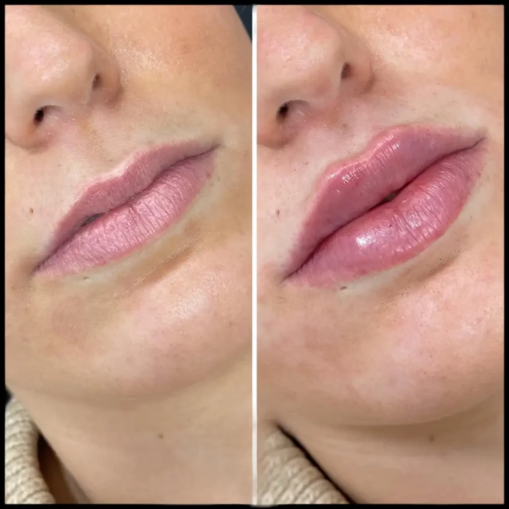 The Best Aesthetic Clinic in Dubai on Preventing Overfilling with Russian Lip Fillers