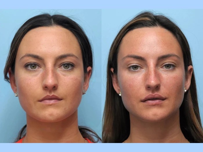 Transform Your Look Instantly with Thread Lift in Dubai