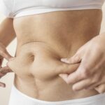 Liposuction in Dubai