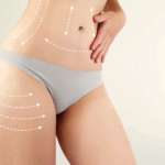 Liposuction in Dubai