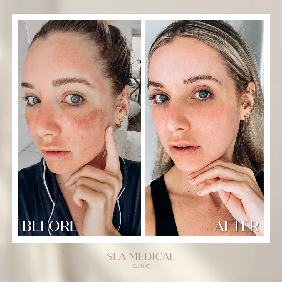 Transform Your Skin With CO2 Laser in Manchester