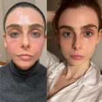 Best Aesthetic Clinic in Dubai Radiofrequency (RF) Microneedling Procedure Guide