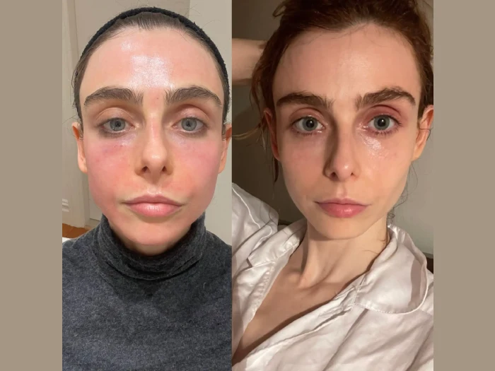 Best Aesthetic Clinic in Dubai Radiofrequency (RF) Microneedling Procedure Guide