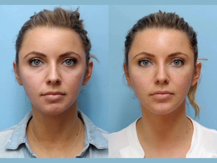 Best Aesthetic Clinics in Dubai Ensures Safe Thread Lift Techniques Every Time