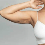Arm Lift in Jeddah for Sleeker, Firmer Upper Arms