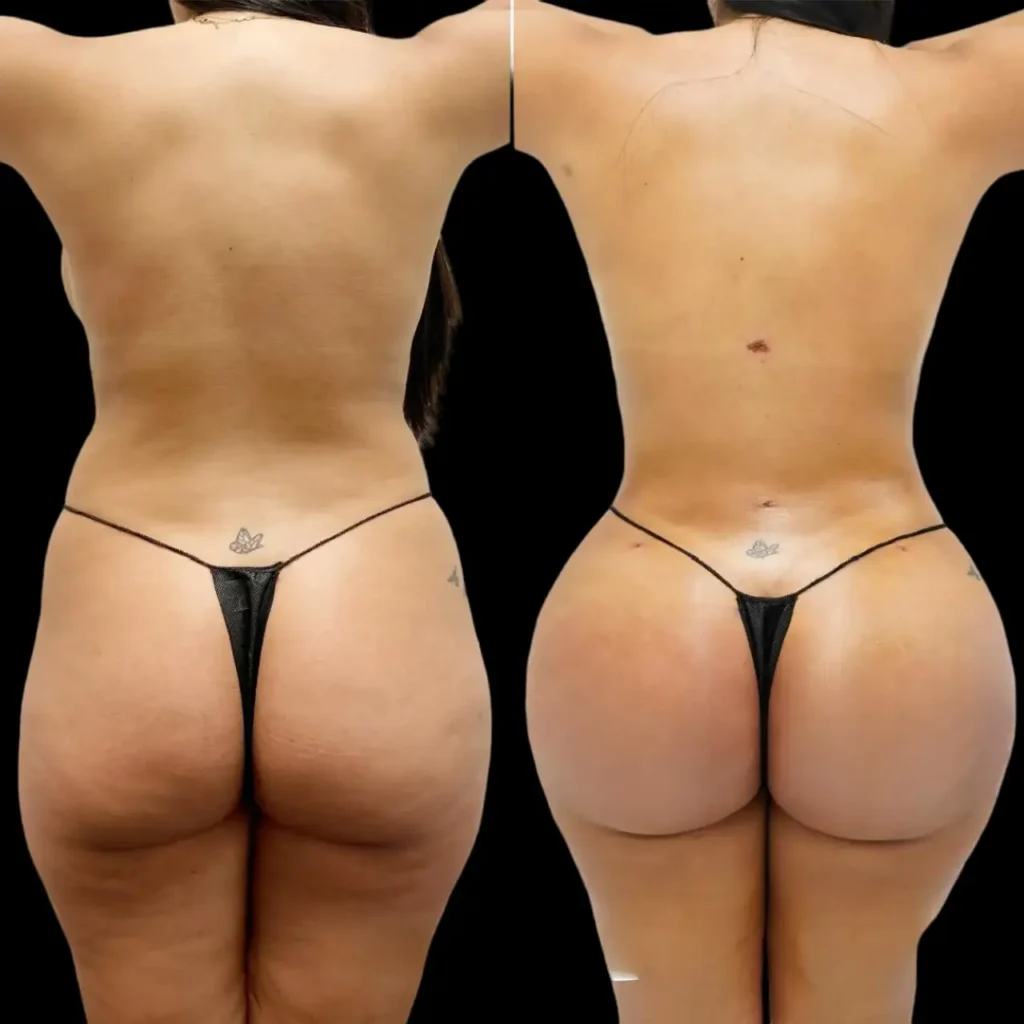 Cost Breakdown: How Much Does Butt Fat Transfer in Dubai Really Cost?
