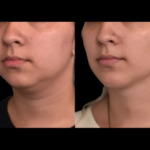 Double chin removal in Dubai