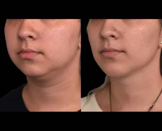 Double chin removal in Dubai