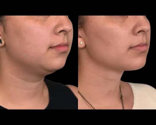 Double chin removal in Dubai