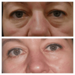 Eye Bag Removal in Dubai