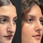 Rhinoplasty in Dubai