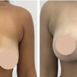 How the Best Breast Lift Surgeons in dubai Ensures Comfort and Safety